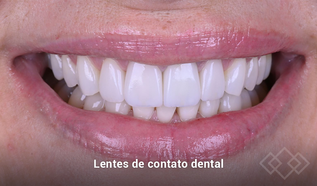 Lentes de contato dental