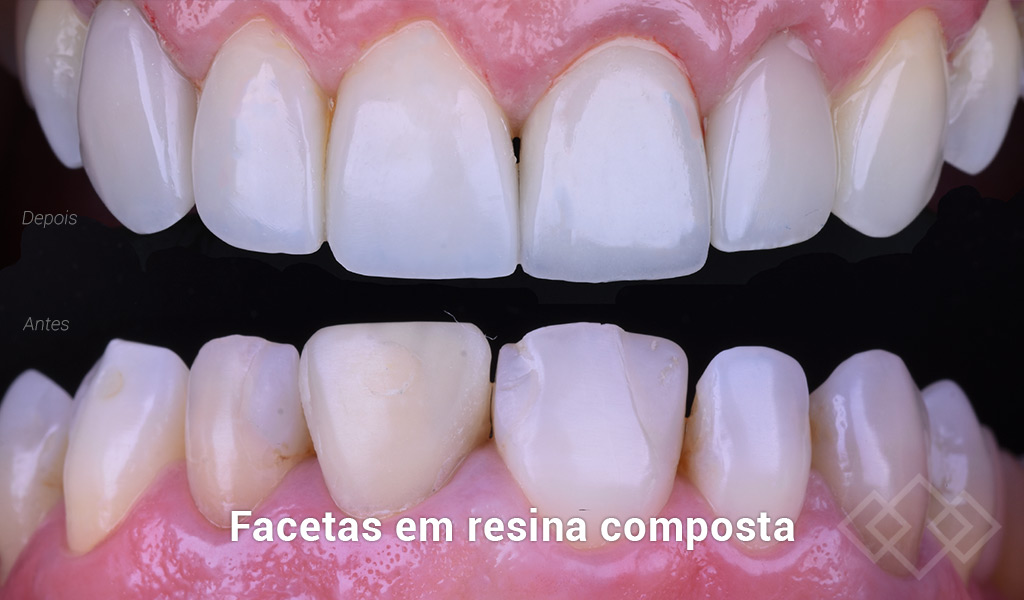 Facetas em resina composta (antes/depois)