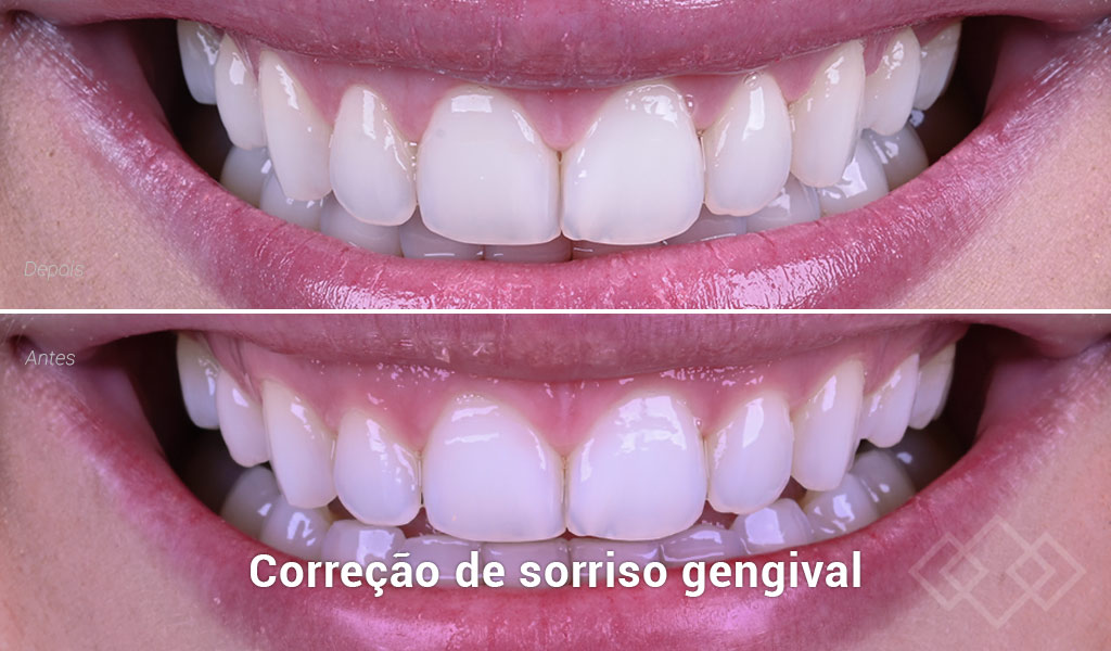 Correção de sorriso gengival