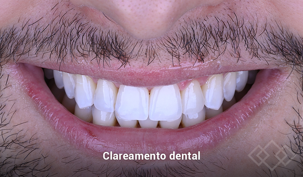 Clareamento dental